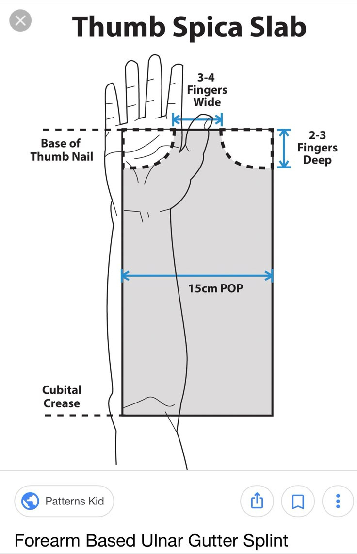 65 Splints Ideas | Hand Therapy, Occupational Therapy, Therapy in Printable Thumb Spica Splint Pattern