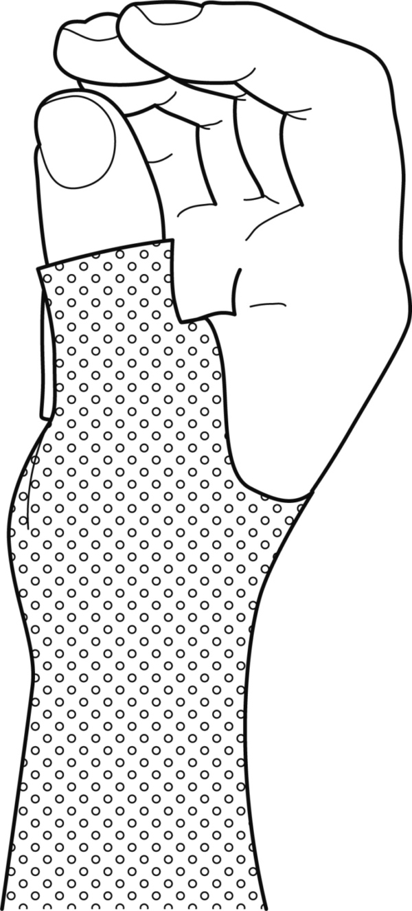 Guide Wrist And Thumb Immobilization Splint throughout Printable Thumb Spica Splint Pattern