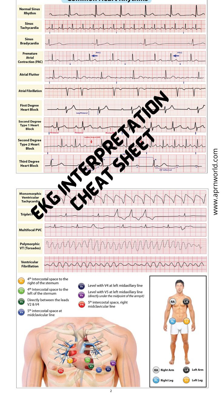 Ekg Interpretation Cheat Sheet - 12 Pages with regard to Free Printable Ekg Interpretation Cheat Sheet