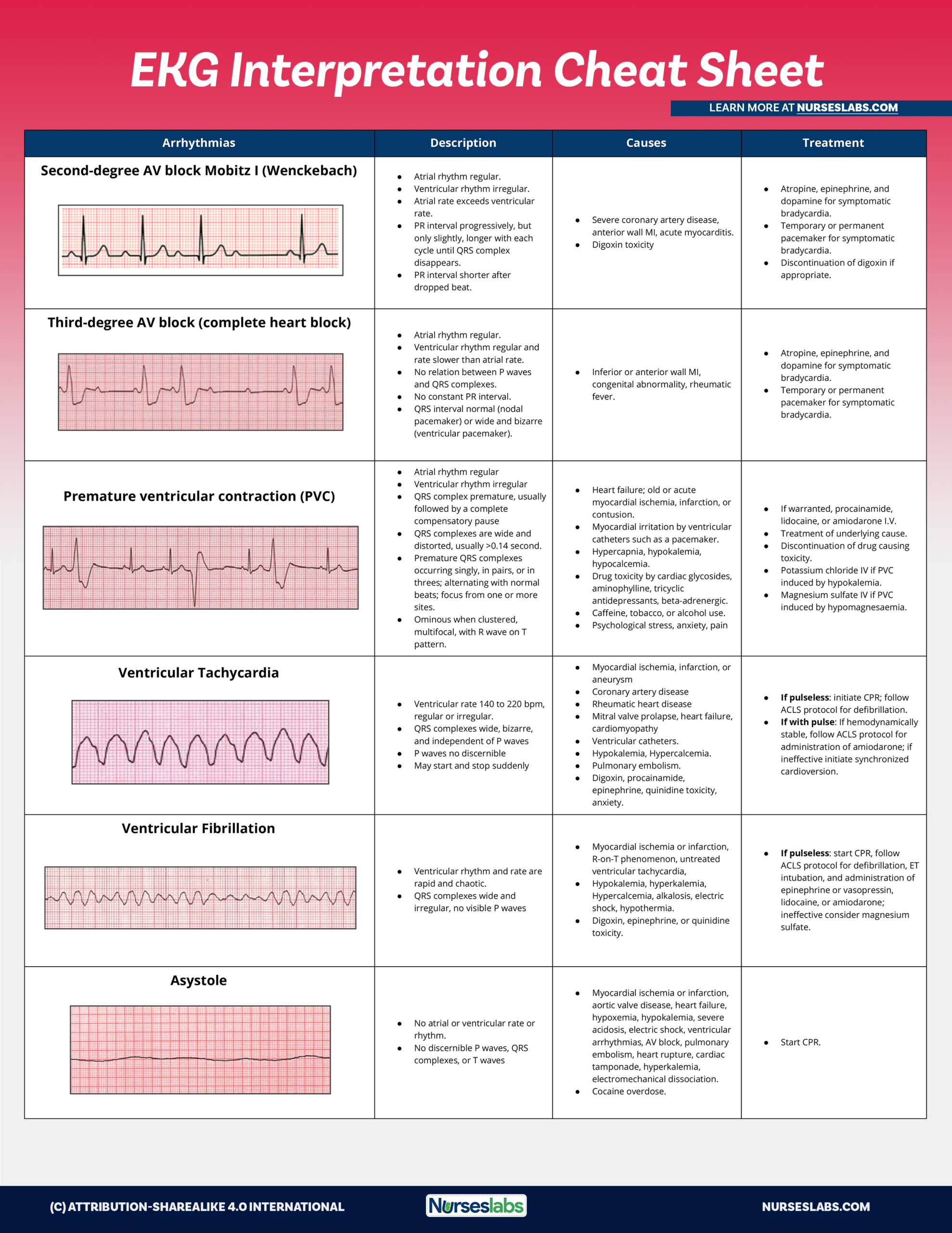 Ekg Interpretation Cheat Sheet &amp;amp; Heart Arrhythmias Guide (2020 Update) pertaining to Free Printable Ekg Interpretation Cheat Sheet